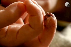 Palec poszkodowanej dziewczynki (fot. kadr TVN)
